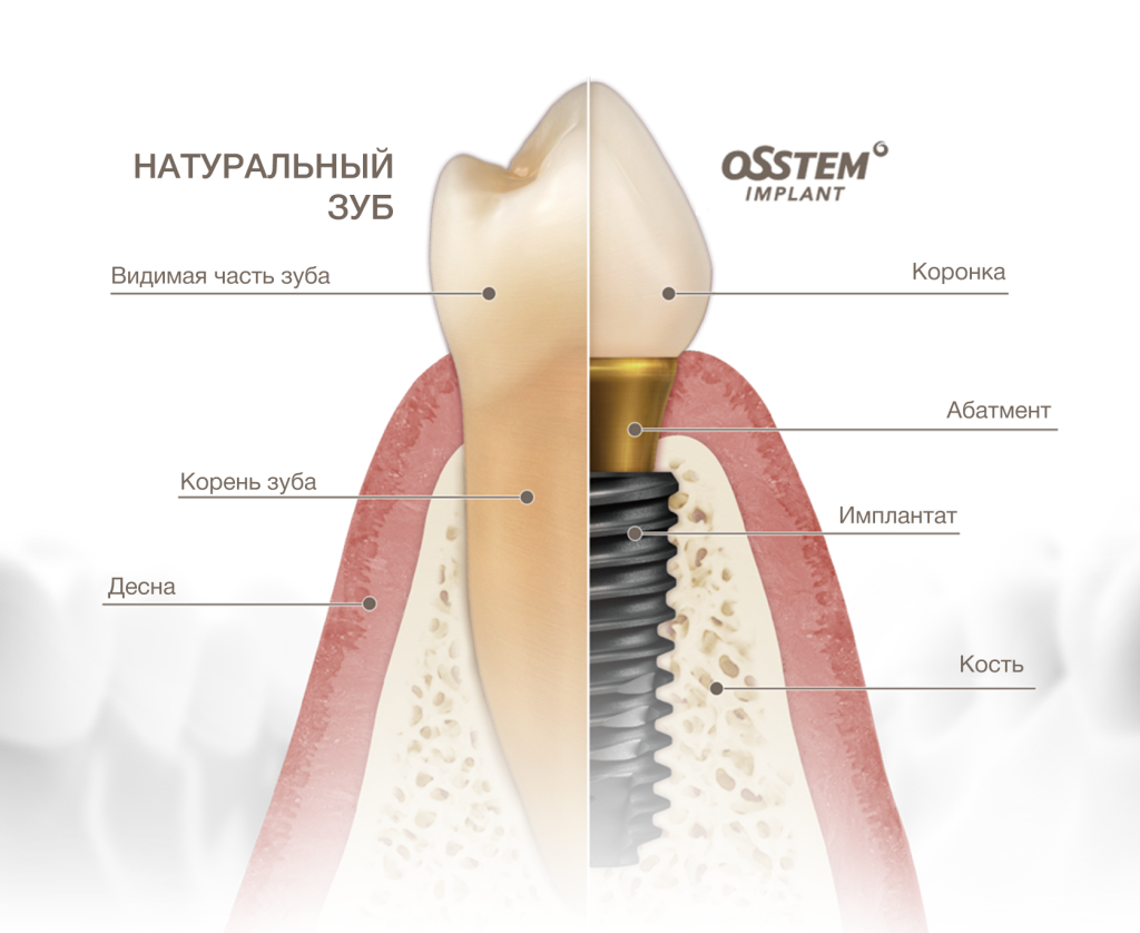 О-дентальной-имплантации_картинка-1.png