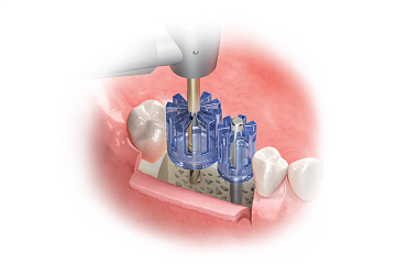 Parallel Guide KIT