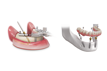 Denture 4U