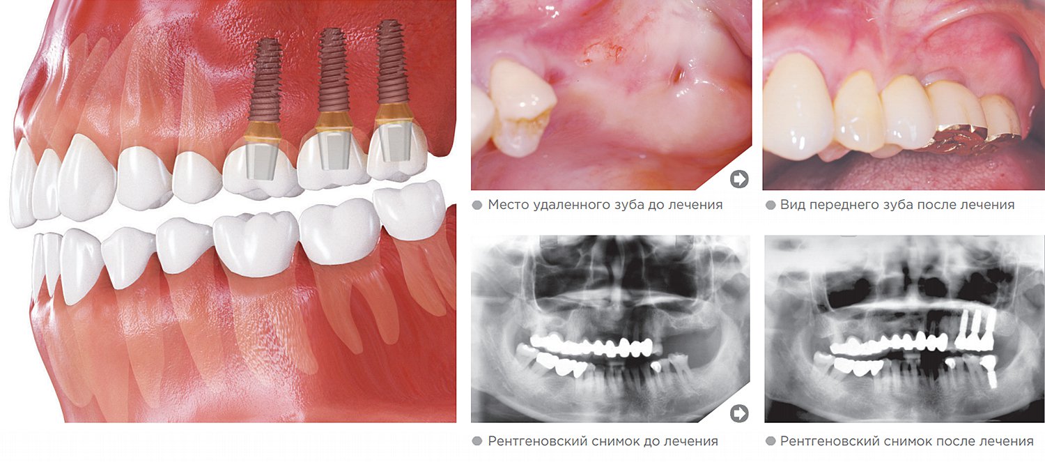 Верхние жевательные зубы (моляры)