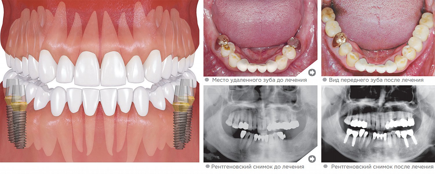 Нижние жевательные зубы (моляры)