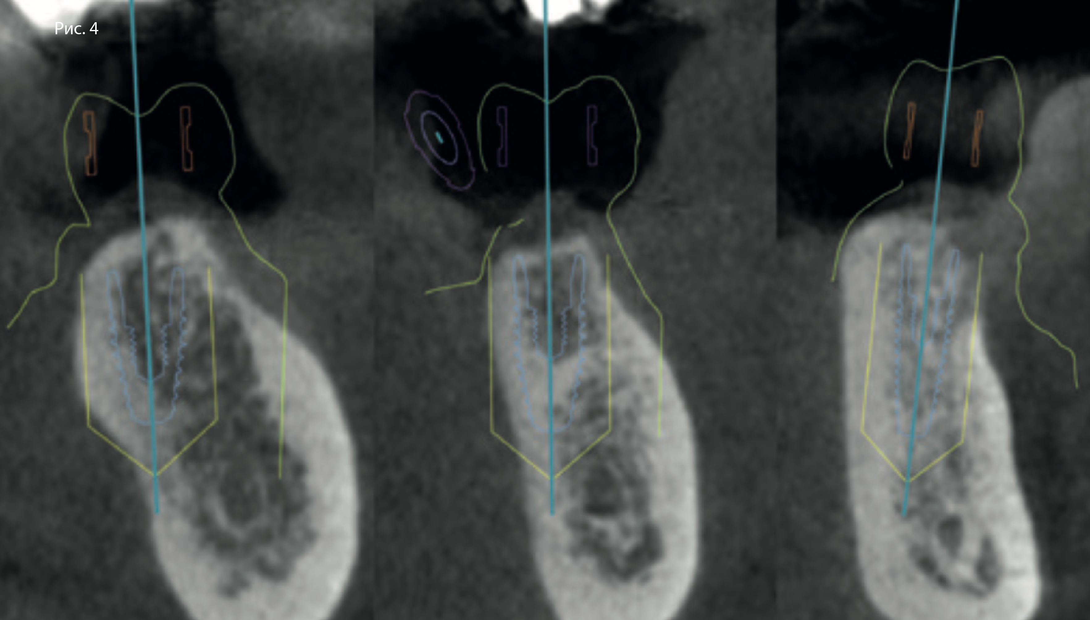Цифровое планирование. Слева направо: участки адентии в позиции зубов 47, 46 и 44