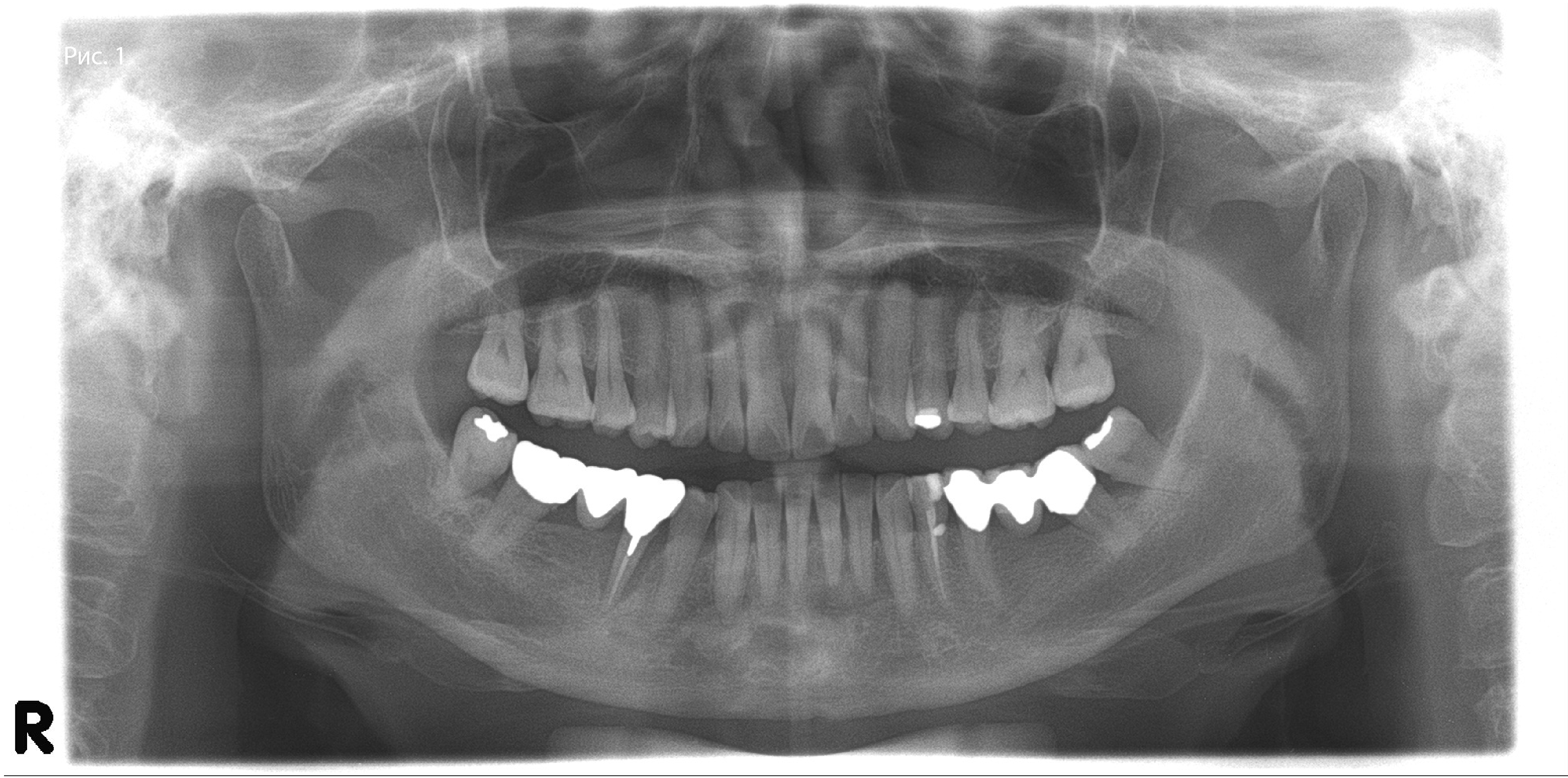 Панорамная рентгенограмма до операции