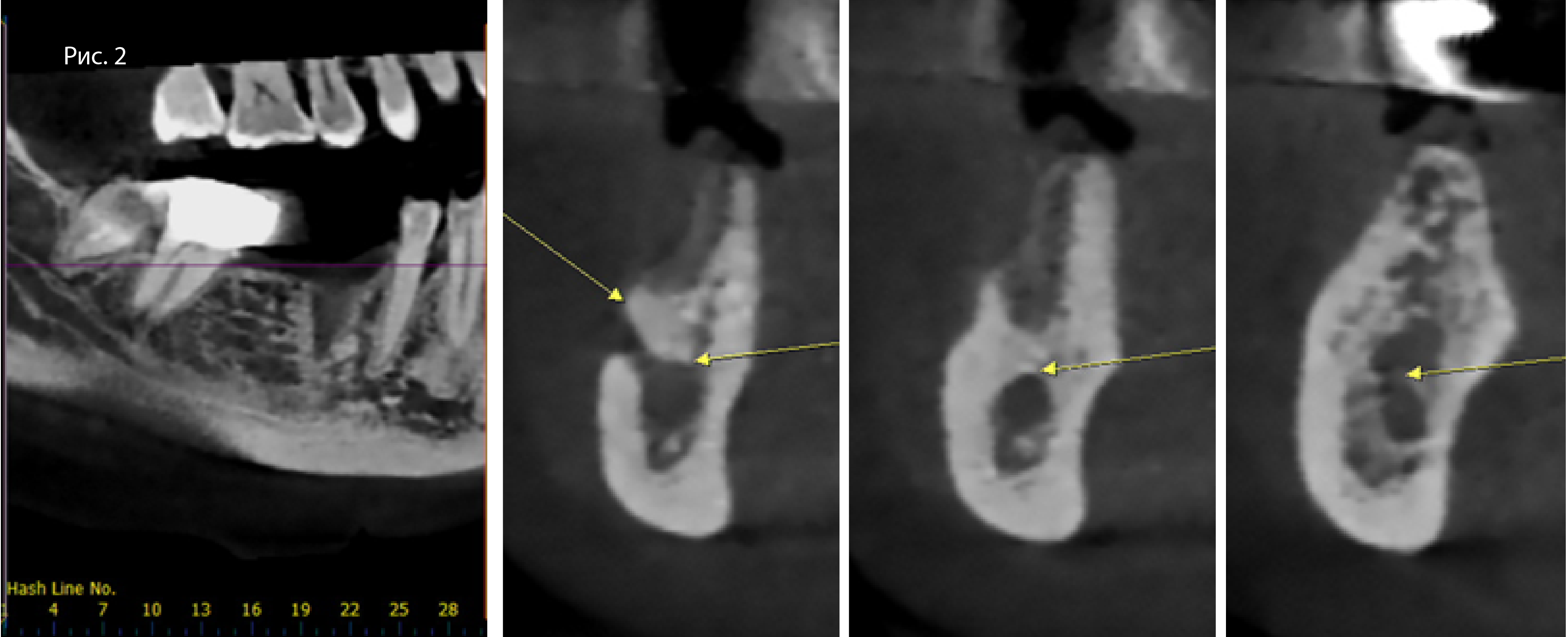 Результаты КЛКТ-исследования через 3 мес. после удаления зуба