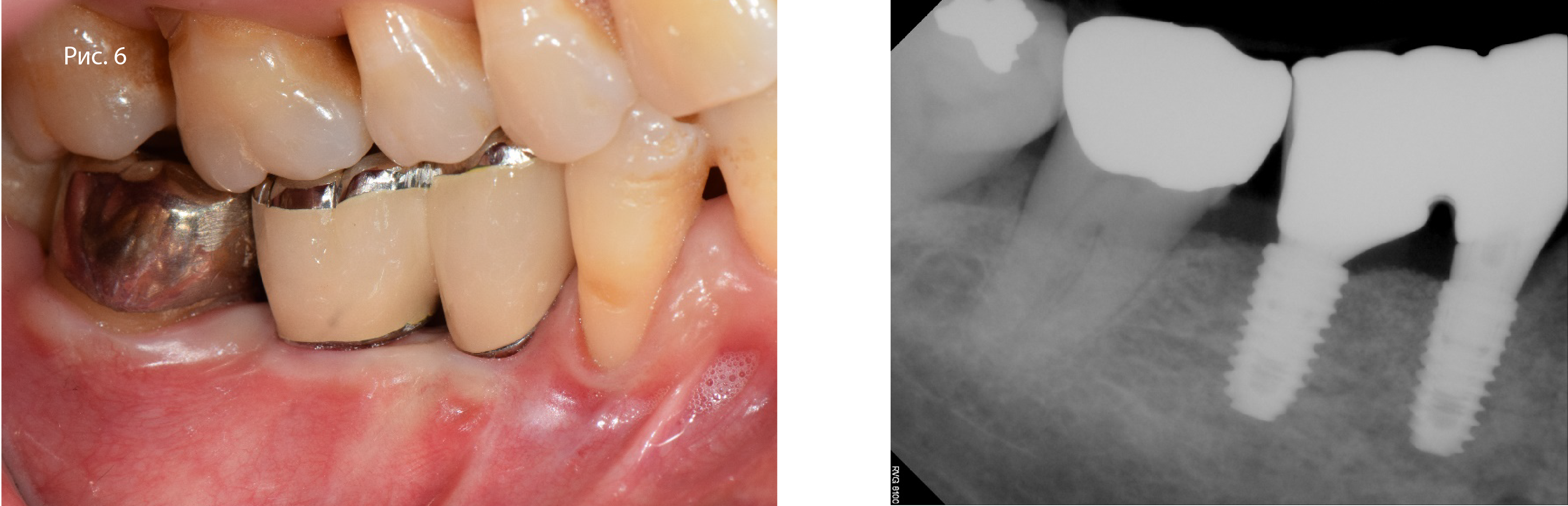 Клинический снимок и прицельная рентгенограмма через 6 нед. после фиксации реставраций