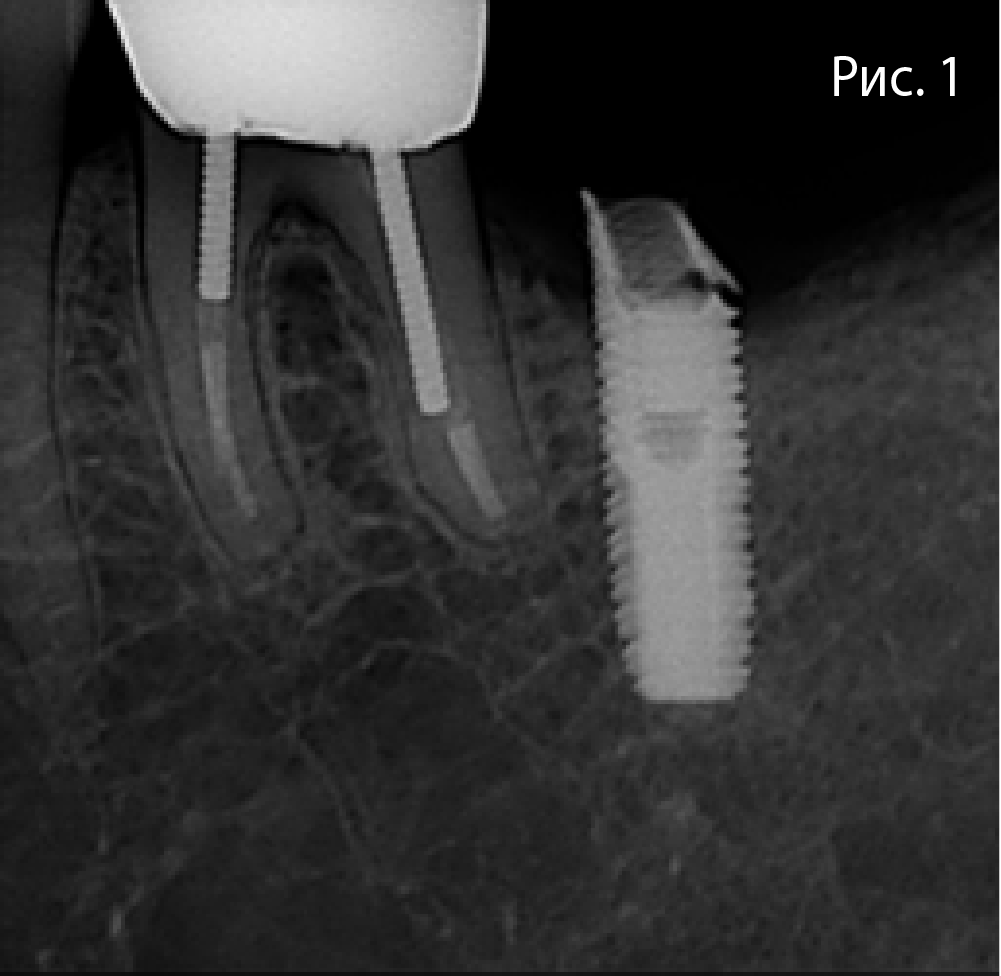 Рис. 1. Перелом имплантата в области зуба 37