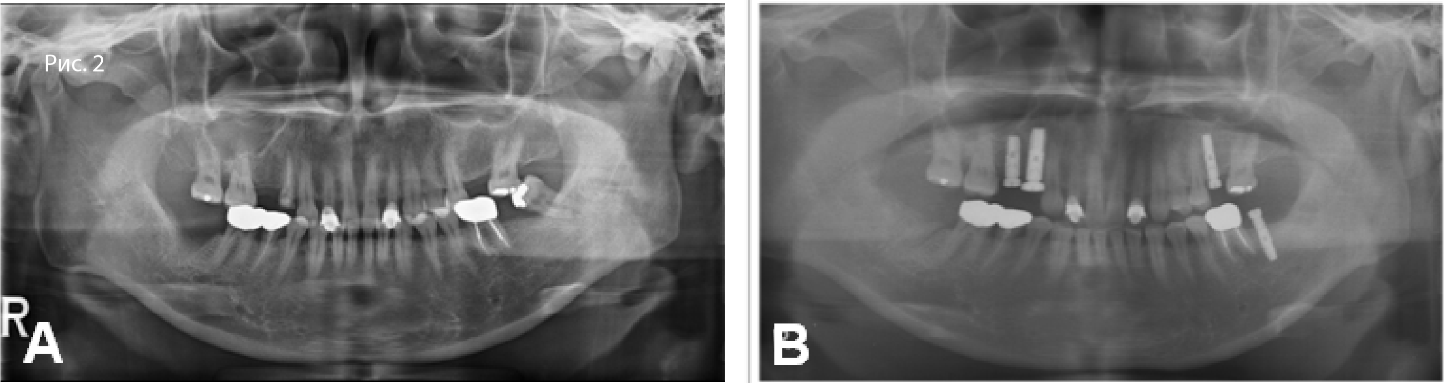 Рис. 2. A. Панорамная рентгенограмма: A. до установки имплантата в области зуба 37; B. после установки имплантата в области зуба 37