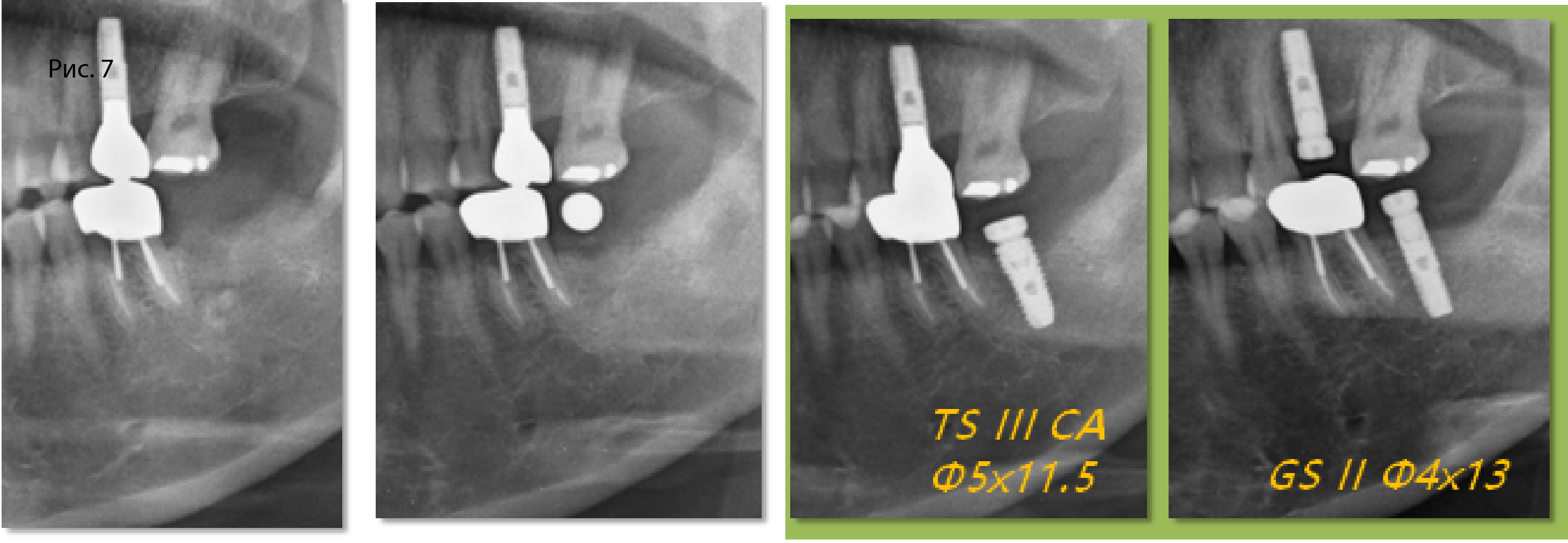 Рис. 7. В области зуба 37 на месте имплантата OSSTEM GS II 4 x 13 мм установили имплантат OSSTEM TS III CA 5 x 11,5 мм 
