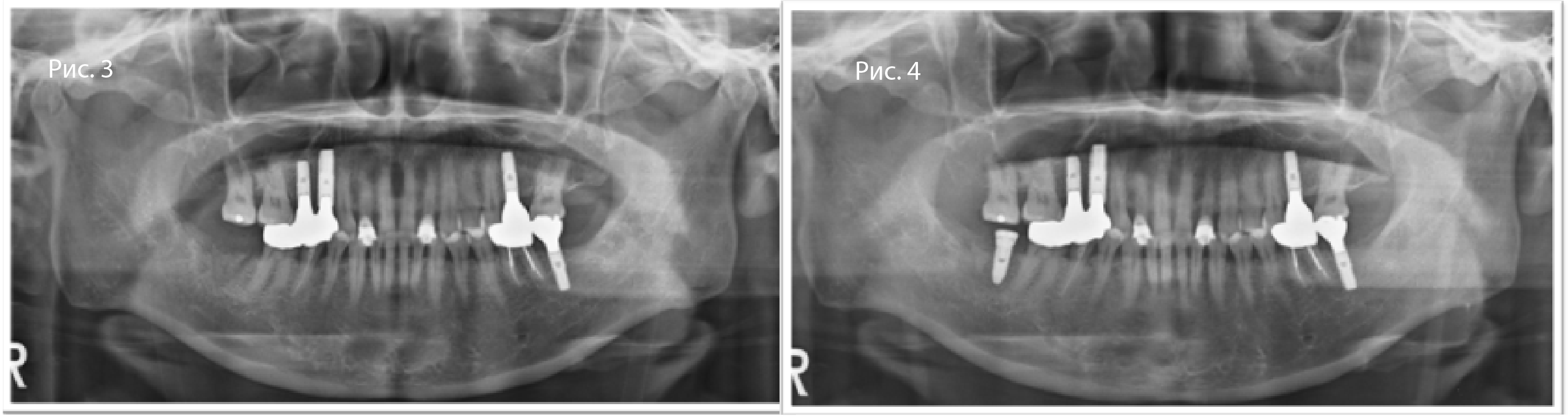 Рис. 3. Панорамная рентгенограмма после фиксации итоговой реставрации (с момента имплантации прошло 2 мес.)