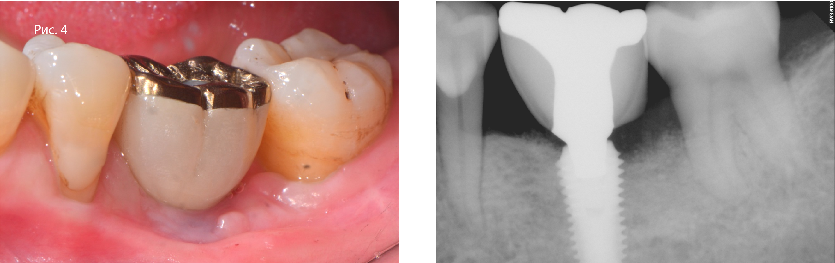 Рис. 4. Клинический снимок и прицельная рентгенограмма через 4 мес. после фиксации реставрации
