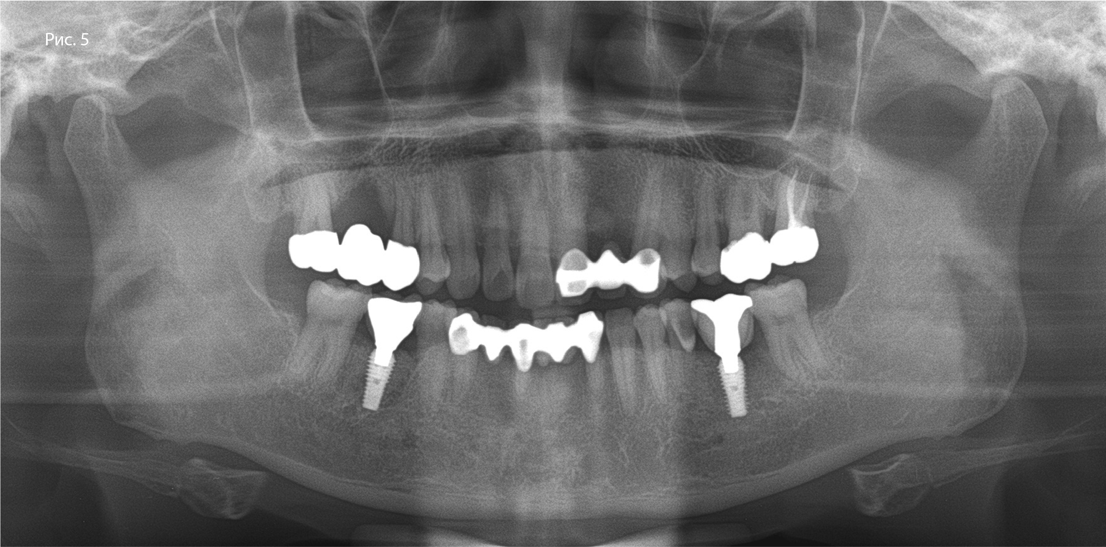 Рис. 5. Панорамная рентгенограмма после операции