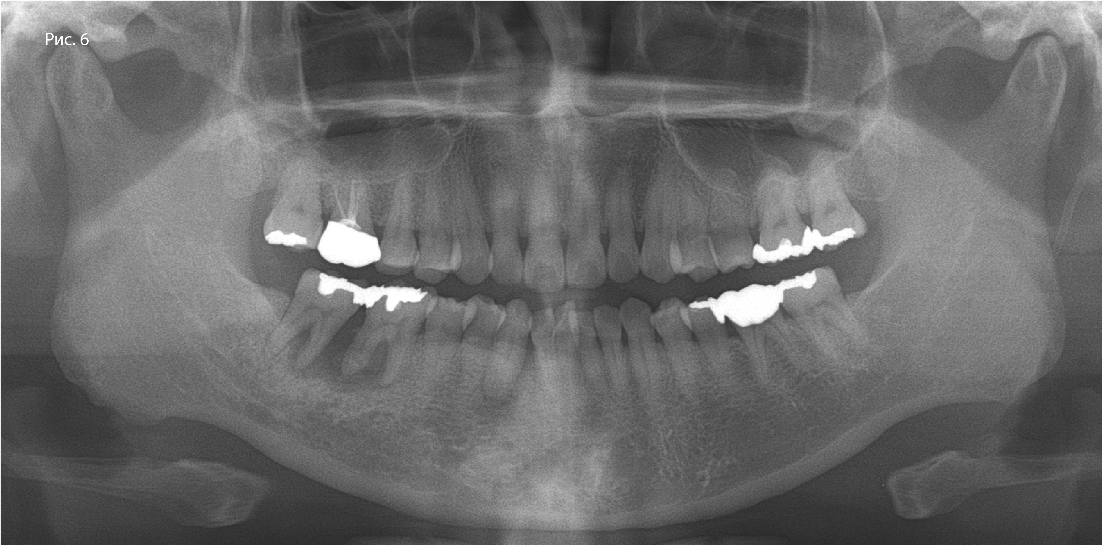 Рис. 6. Исходная панорамная рентгенограмма