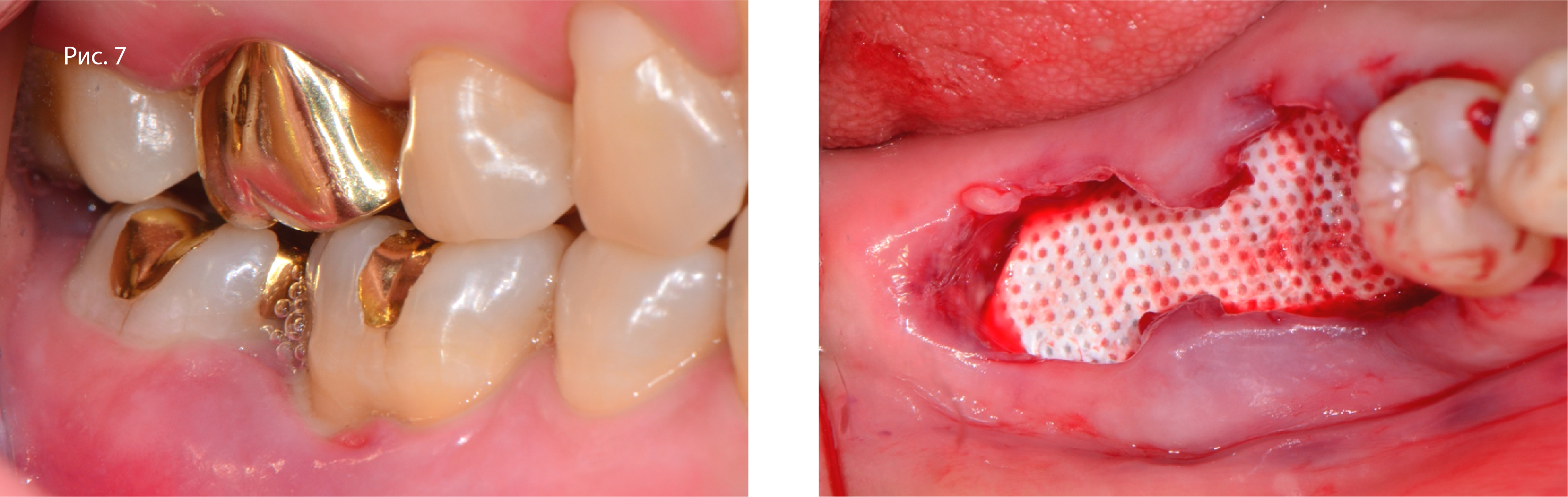 Рис. 7. Клинические снимки до и после удаления зубов