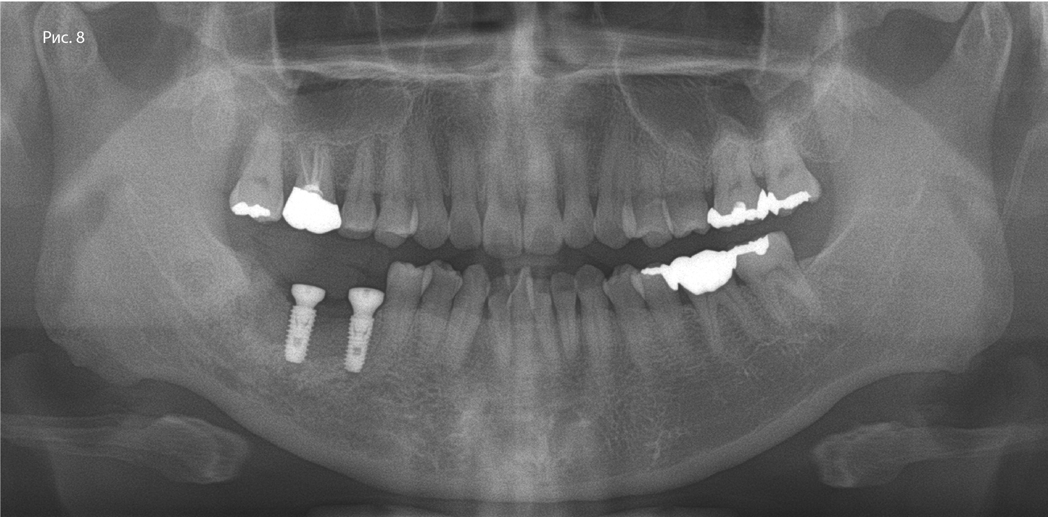 Рис. 8. Панорамная рентгенограмма через 6 мес. после направленной костной регенерации