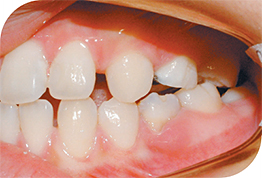 Увеличение расстояния между зубами